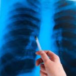 Березень — місяць подолання туберкульозу і нагода розповісти проактуальність і важливість боротьби з цією хворобою